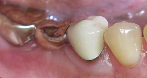 Pinhole® Surgical Technique - Zahnarztpraxis Christiane Wittenhagen in 87700 Memmingen